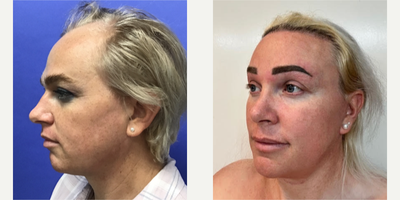 Patient treated with Facial Feminization Surgery, Transgender Facial Feminization Surgery, Septoplasty, Rhinoplasty, Cheek Augme - 25 to 44 year-old female patient is 2 years post-op from Facial Feminization surgery. Her procedures included: Placement of Tissue Expander for Mayer Flap, Forehead Lift and Orbital Bony Contouring, Septorhinoplasty (closed) with Cartilage Grafts and Weirs, Cheek Implants (small), Chin Reduction and Contour, Subnasal Lip Lift with Fat Augmentation to Lips, Medium Facelift, 1cc Voluma, Juvederm, Periorbital TCA Peel, and Mole Removal on Face. Patient is 1 year 5 months post-op from Removal of Tissue Expander and Rotate Flap. Patient is 3 months post-op from Dog Ear and 800 Micrografts to Hairline.