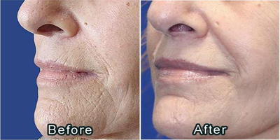 Woman treated with Secret RF - Woman treated with Secret RF.