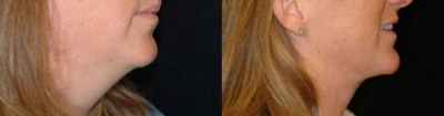 Neck Lift - Woman treated with Neck Lift-
