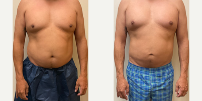 45-54 year old woman treated with Brazilian Butt Lift, Liposuction - 49 year old male underwent liposuction 360 of abdomen and flanks. Fat transfer to buttocks. 7 weeks post op.