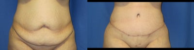 Abdominoplasty (Tummy Tuck) - The patient is a 36 year old female who was unhappy with the appearance of her mid-section post childbirth. Dr. Franco performed a full abdominoplasty with liposuction to the flanks.