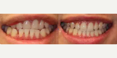 Man treated with Invisalign - Patient presented with a chief complaint of displeasure with his underbite which made it difficult to chew properly and was leading to his gums receding. Invisalign treatment took 15 months to complete. Patient was so pleased with his new smile and his ability to chew food properly.