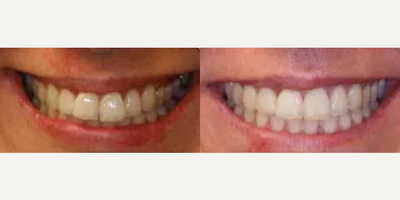 Woman treated with Invisalign - Patient was unhappy with the upper smile. She felt her front teeth stuck out like a bunny. Clear aligner treatment was used to give a more harmonious, healthier, natural, younger smile.