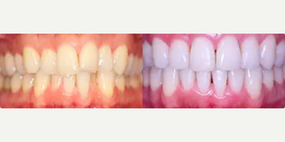 Woman treated with Invisalign - Patient was very unhappy with the look of her teeth. She felt they looked aged and crowded. Invisalign treatment was used to correct the poor angulations and crowding and cosmetic dental bonding was used to correct the chipped and uneven upper front two teeth.