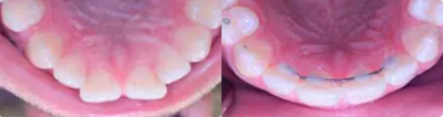 Woman treated with Invisalign - Patient presented with the chief complaint of an uneven upper smile and buck-spaced front teeth Clear aligner treatment took 4 months to complete with the use of the accelerated Propel technique.