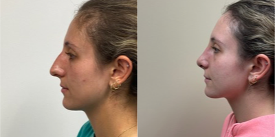 18-24 year old woman treated with Rhinoplasty - 16 days after a rhinoplasty