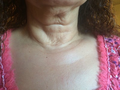 thyroidectomy partial wrinkles corrected result left neck