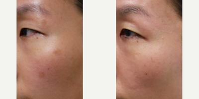 Asian Age Spot Removal Before and after photos Los Angeles - Asian patient with brown spots on the cheeks before and after q-switched laser treatments for age spot removal.  The tone of your skin does not matter when it comes to removing brown spots.  we can treat white, Asian, Hispanic and even African American for brown spot removal.  Call today to learn more about getting rid of your age spots.