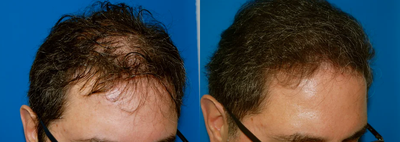 Hair Restoration Surgery | Hair Transplant - 	Hair Transplant for treatment of Alopecia (Male Pattern Baldness)