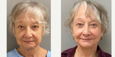 78 year old woman treated with Facelift/Necklift - 78 yo s/p Naturalyft facelift/ neck lift performed under local anesthesia with sedation in our on site AAAA certified operating suite.
