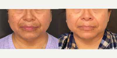 45-54 year old woman treated with Potenza - Results after 3 treatments of Potenza (micro needling with RF.)