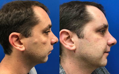 35-44 year old woman treated with Cyst Removal - Excision done on this man's face to remove cysts in that area.