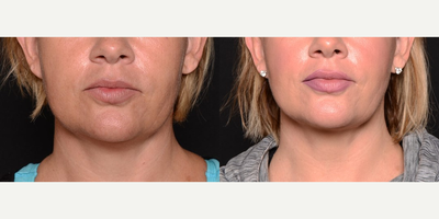 35-44 year old woman treated with FaceTite - Age: 40 - 49. FaceTite procedure to tighten up jowels and neck