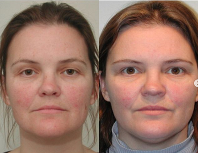 Patient treated with Blue Peel - Here is a before and after picture of a patient's results using Obaji Blue Peel. Obaji Blue Peel will reverse sun damage, remove pre-cancerous spots, and is an excellent option for anyone who wants to look better and reverse the aging process. Patients who have blemish-prone skin, wrinkles, pigmentation problems, sun damage, or general poor skin quality will benefit the most.