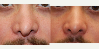 25-34 year old man treated with Silikon 1000 for nonsurgical revision rhinoplasty. - You can see a natural looking nasal appearance in our patient following a single non-surgical rhinoplasty treatment with Silikon-1000, an off-label filler for permanent results. Our gracious patient had previous rhinoplasty and was dissatisfied with his nasal appearance. In this instance, Silikon-1000 was used to lower retracted nostrils, and to provide a more symmetrical and unoperated nasal appearance.