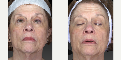 65-74 year old woman treated with Microdermabrasion - Tyte & Bryte procedure used on this woman's face.