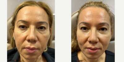 45-54 year old woman treated with PRP Injections - Dr. Song's signature Autocorre PureBioFill Gel.