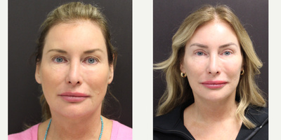 45-54 year old woman treated with Mini Facelift, TCA Peel, Eyelid Surgery, Brow Lift, Lip Fillers - 54 year old female one month following  lateral brow lift, upper lid blepharoplasty, and mini facelift and TCA peel with one vial of Juvederm to the lips.