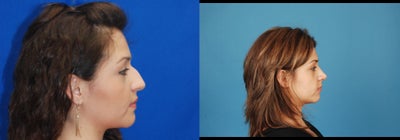 Rhinoplasty - 
	rhinoplasty
