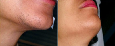 25-34 year old man treated with Neo Laser - Laser hair removal