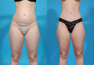 35-44 year old woman treated with Mini Tummy Tuck and Diastasis Recti Repair - Mini Tummy Tuck with liposuction of the flanks