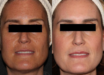 FRAXEL 1927 - Before &After - Chronic Photodamage, Lentigines