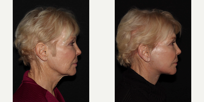 55-64 year old woman treated with Facelift - MD Restore, Deep-Plane