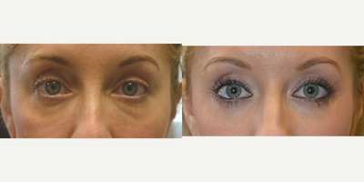 37 year old female, underwent lower blepharoplasty after dissolving filler. - 37 year old female, with history of unsuccessful under eye filler (to camouflage under eye fat bags) underwent initial hyaluronidaze to dissolve the filler followed later by transconjunctival lower blepharoplasty with fat bags repositioning and skin pinch. Before and 3 months after eyelid surgery photos are shown.