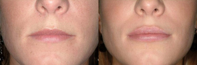 25-34 year old woman treated with Lip Implants - Perma Facial Implant by Surgisil.