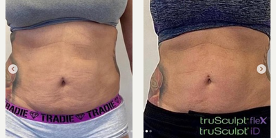Woman treated with truFlex, truSculpt - Woman treated with truFlex, truSculpt