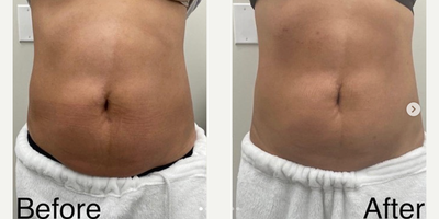 Woman treated with truSculpt - Woman treated with truSculpt