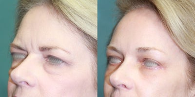 55-64 year old woman treated with Forehead Lift - Patient underwent forehead lift and extended lower lid lift