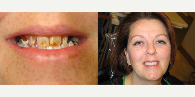 35-44 year old woman treated with Dental Crown, Dental Implants, Full Mouth Reconstruction, Smile Makeover - After years of taking care of her family, it was time to focus on me! I think the end result was amazing!