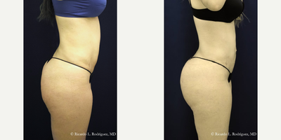 35-44 year old woman treated with Brazilian Butt Lift - 35-44 year old woman treated with Brazilian Butt Lift