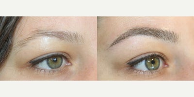25-34 year old woman treated with Microblading, Permanent Makeup - Microblading is a precision-based form of cosmetic tattooing designed to enhance and restore natural brow shape. Each treatment is performed by Ruth Swissa, CMM, a leading expert in medical micropigmentation.Using a sterile, single-use microblade, ultra-fine pigment is deposited into the superficial dermis to create realistic, hair-like strokes that blend seamlessly with existing brow hair. Each procedure includes a detailed facial analysis and custom brow mapping to ensure symmetry, balance, and a tailored result.Ideal for patients with thinning brows, asymmetry, or hair loss, microblading delivers soft, natural-looking enhancement with results that continue to refine as the pigment settles. *A follow-up session is recommended to perfect the final outcome.