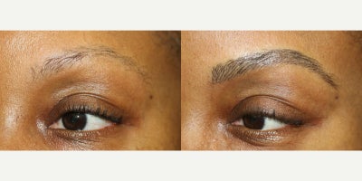 35-44 year old woman treated with Microblading, Permanent Makeup - Microblading is a precision-based form of cosmetic tattooing designed to enhance and restore natural brow shape. Each treatment is performed by Ruth Swissa, CMM, a leading expert in medical micropigmentation.Using a sterile, single-use microblade, ultra-fine pigment is deposited into the superficial dermis to create realistic, hair-like strokes that blend seamlessly with existing brow hair. Each procedure includes a detailed facial analysis and custom brow mapping to ensure symmetry, balance, and a tailored result.Ideal for patients with thinning brows, asymmetry, or hair loss, microblading delivers soft, natural-looking enhancement with results that continue to refine as the pigment settles. *A follow-up session is recommended to perfect the final outcome.
