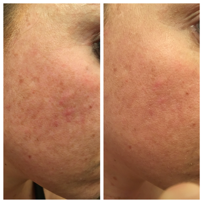 perfect image peel reviews