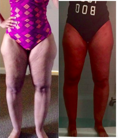 35-44 year old woman treated with Tumescent Liposuction - vaser and body jet liposculpture of the thighs/legs in a patient with lipedema. see the transition from before and 6 weeks after treatment.