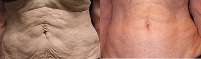 Venus Freeze - Photos provided courtesy of Venus Concept