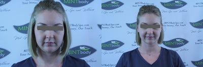 25-34 year old woman treated with TriPollar - 30 year old female presents with concerns of hyperpigmentation as a result of sun damage, mild rosacea, and mild skin laxity. The Venus Tribella treatment was performed. This three layer treatment consists of IPL laser, skin tightening with RF, and a nano-fraxel resurfacing laser. Her down time was approximately one week.