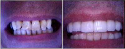 Dental implants to restore bite and cosmetics - The missing back teeth were restored with dental implants, bone grafting, and porcelain Zerconia aesthetic crowns. The front teeth were completed with dental veneers, so when combined with dental implants and porcelain crowns.