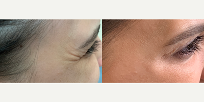 25-34 year old woman treated with Botox - Botox to treat crow's feet.