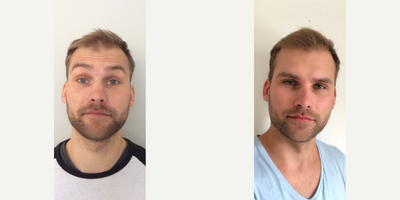 25-34 year old man treated with Micro Botox - Botox injectable treatments can also be used to minimize the lines around the mouth, nose, frown lines, and crows feet, to smooth the chin, relax the jawline and neck bands and to create a lift to the brow. In addition, Botox injections can be used for a brow lift, treat excess sweating (hyperhydrosis), slim the calf muscle, facial muscles, and fix gummy smiles.