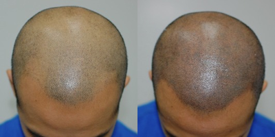 25-34 year old man treated with Scalp Micropigmentation - Scalp Micropigmentation