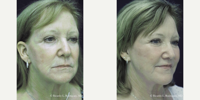 65-74 year old woman treated with Facial Fat Transfer - 65-74 year old woman treated with Facial Fat Transfer
