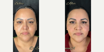 45-54 year old woman treated with Emface - Before & After EMFACE