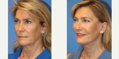 55-64 year old woman treated with Facelift, Laser Genesis, Lip Lift - This is a 62 year old female otherwise healthy with signs of facial ageing including elongation of the upper lip, skin laxity of the face and neck causing jowling, loss of the cervicomental (chin/neck) angle, platysma banding, soft tissue descent of the midface, nasolabial folds. The patient underwent deep plane facelift, lip lift. Photos are before and 5 months post op. The patient underwent post op facelift protocol including lymphatic massage, laser genesis and scar cream application to enhance/ accelerate her healing process.