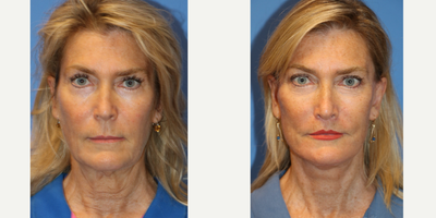 55-64 year old woman treated with Facelift, Laser Genesis, Lip Lift - This is a 62 year old female otherwise healthy with signs of facial ageing including elongation of the upper lip, skin laxity of the face and neck causing jowling, loss of the cervicomental (chin/neck) angle, platysma banding, soft tissue descent of the midface, nasolabial folds. The patient underwent deep plane facelift, lip lift. Photos are before and 5 months post op. The patient underwent post op facelift protocol including lymphatic massage, laser genesis and scar cream application to enhance/ accelerate her healing process.