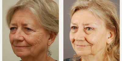 65-74 year old woman treated with Brow Lift - 2 months after a brow lift and upper eyelid blepharoplasty.