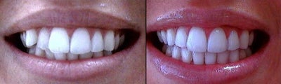 Invisalign - Before and after Invisalign